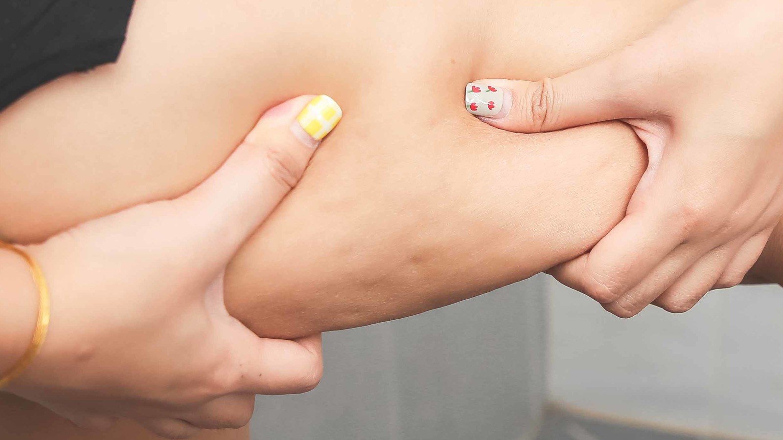 il lipedema puo colpire anche donne magre