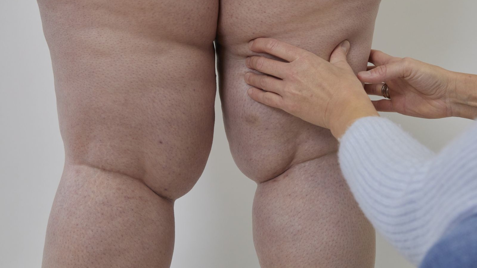 lipedema e altre patologie comorbidita frequenti