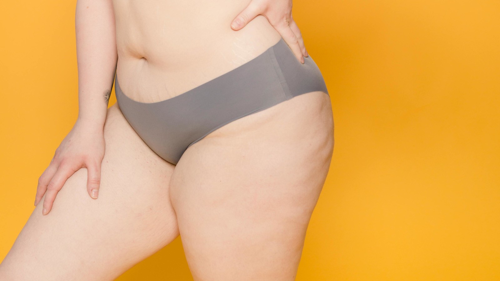 lipedema e genetica il ruolo dellereditarieta