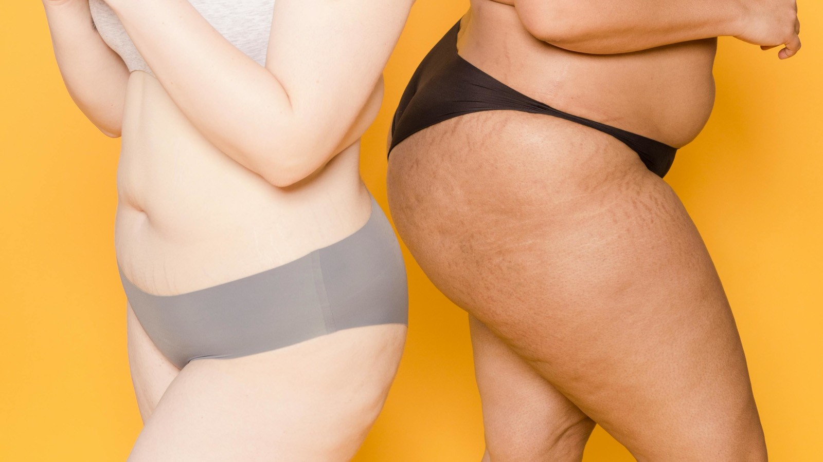 lipedema e menopausa cambiamenti ormonali e peggioramento