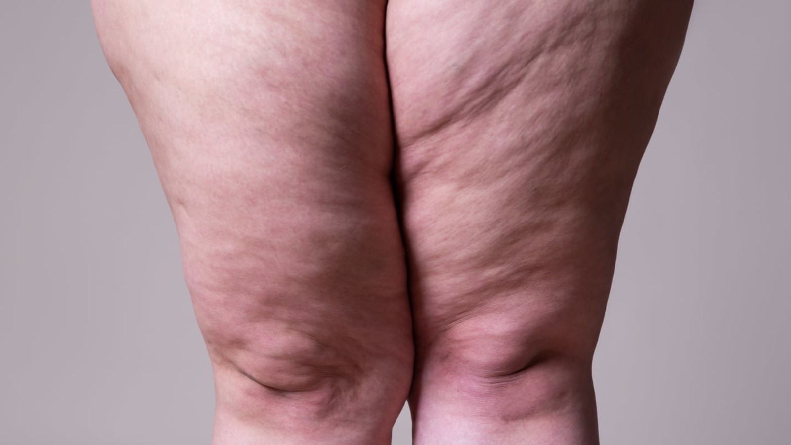 lipedema e traumi possibili fattori scatenanti