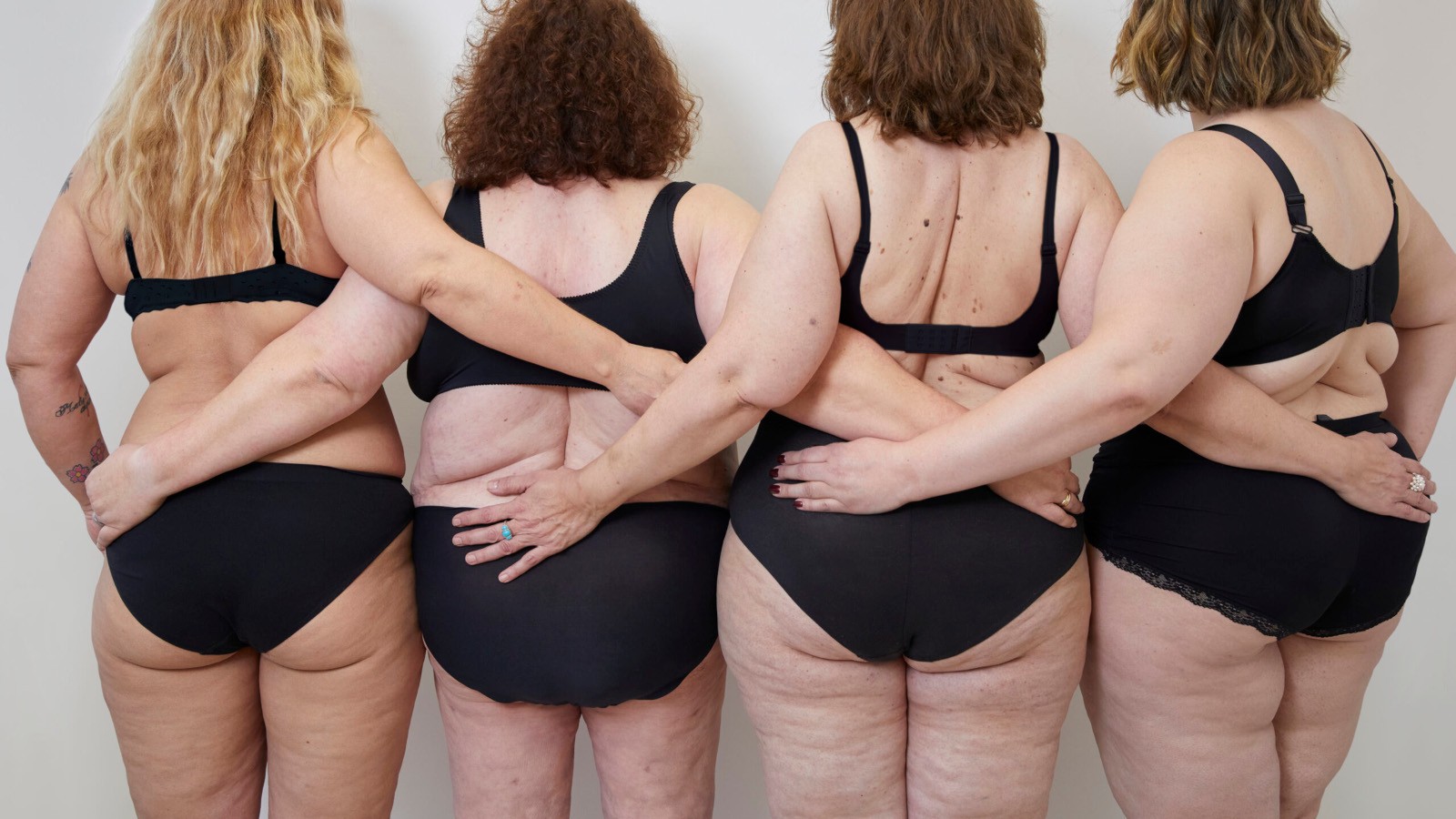 lipedema malattia reale non immaginaria