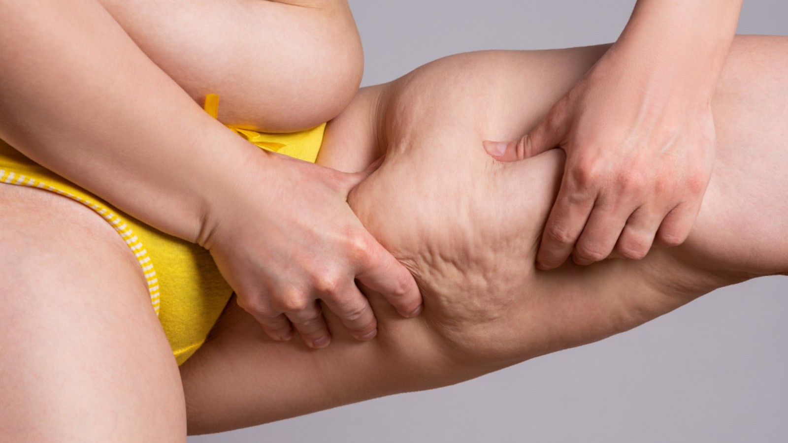 lipedema nelle donne vs uomini perche colpisce principalmente il sesso femminile
