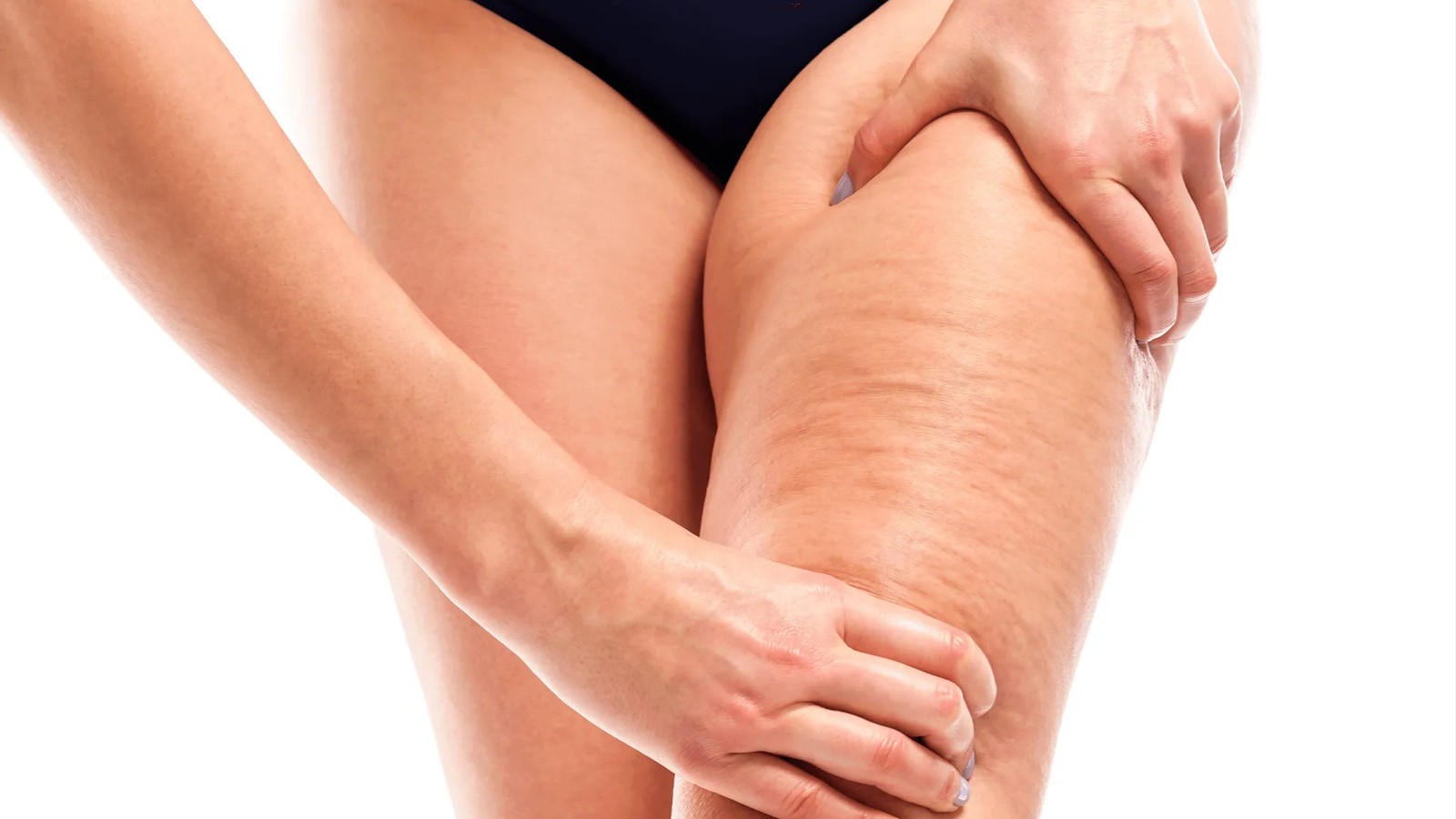 lipedema screening identificazione precoce dei casi