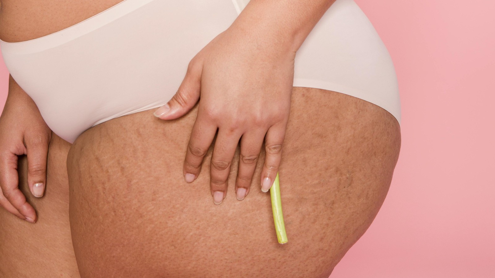 lipedema terapia compressiva calze e bendaggi terapeutici