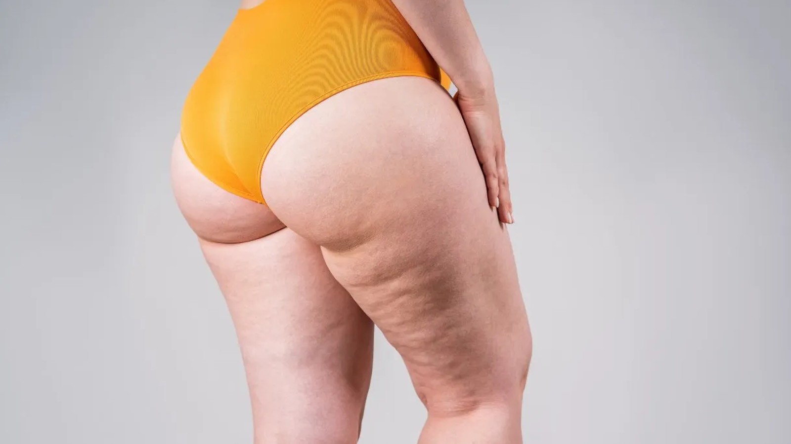 lipedema vs dermatite da stasi distinguere le manifestazioni cutanee