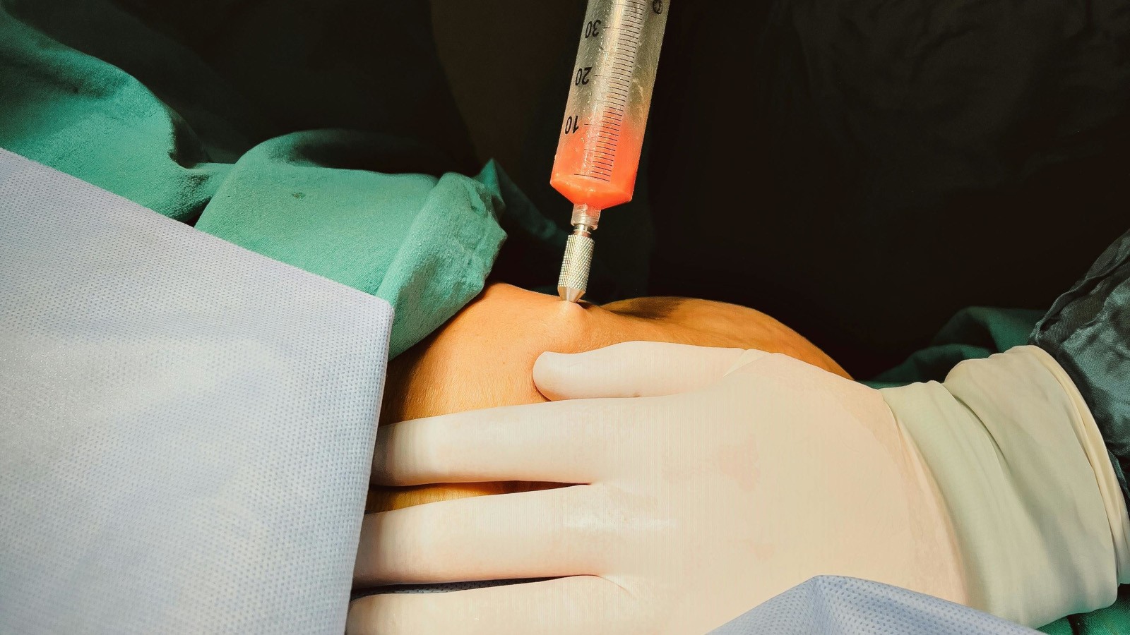 liposuzione per lipedema quando e indicata e risultati attesi