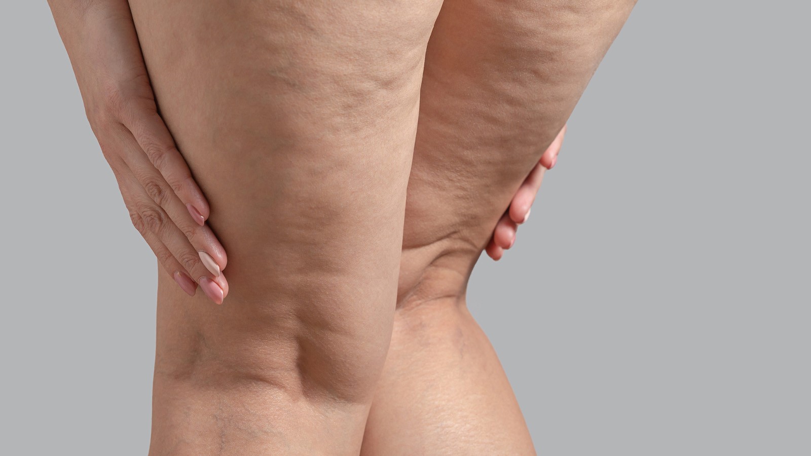 quando e necessario operare il lipedema